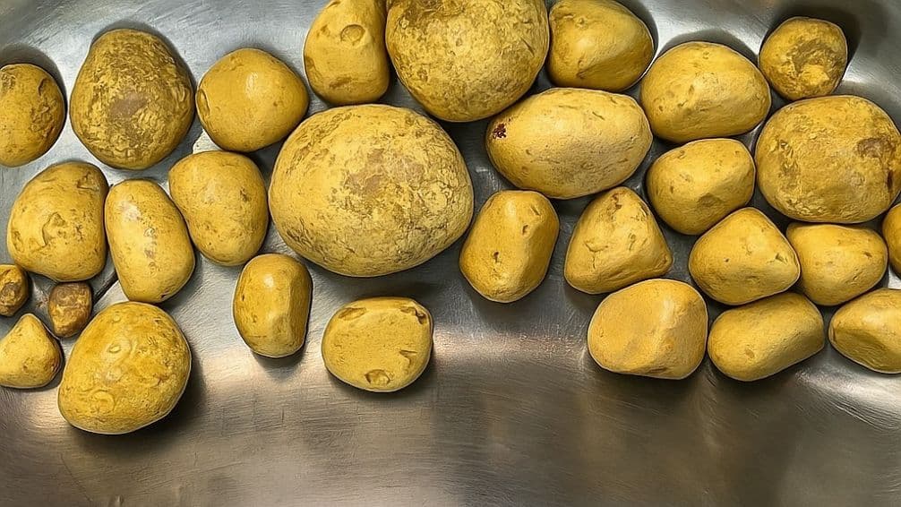 Ver para creer: extrajeron 35 piedras de la vejiga de un hombre adicto a una conocida gaseosa